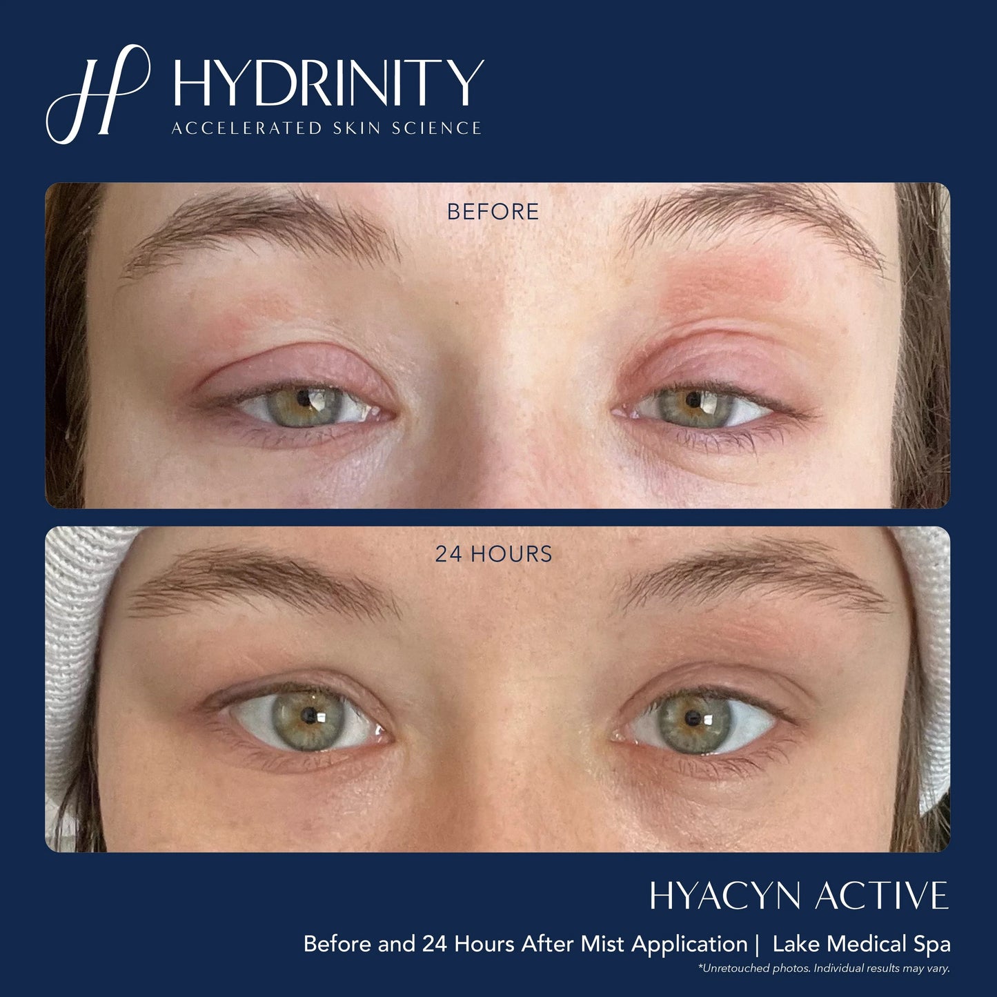Hyacyn Active Rose Gold